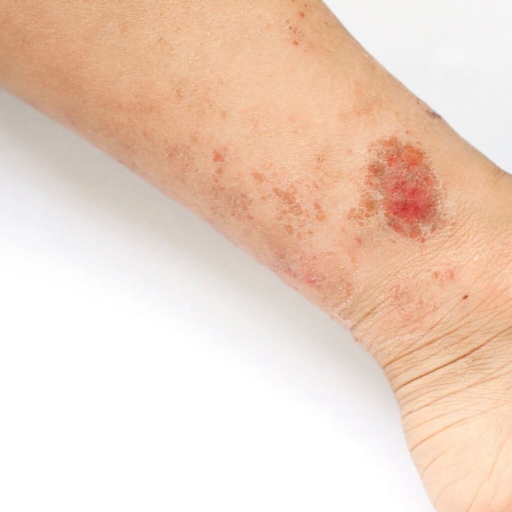 Overcoming Eczema: Discover Natural Help with Eczema Today!